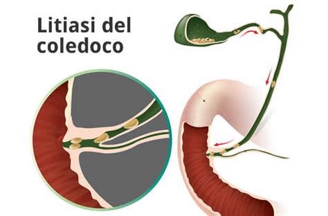 ghiandole skene|Cisti del dotto di Skene